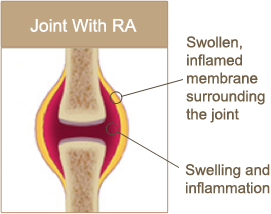 Joint with RA